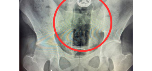 Jovem é internado após ficar com desodorante preso no reto; médico faz alerta