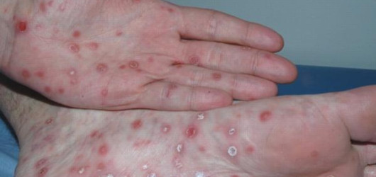 Mais de 5 mil casos de sífilis são registrados entre jovens no Piauí