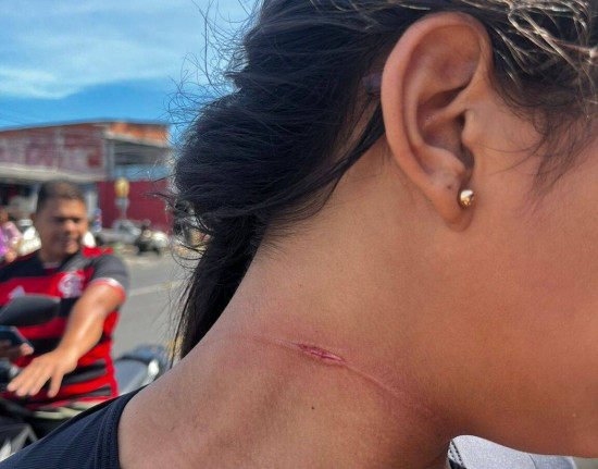 Mulher sofre cortes ao ser atingida por linha com cerol na zona Norte de Teresina