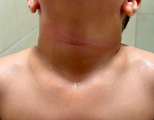 Criança fica ferida por linha com cerol em Parnaíba