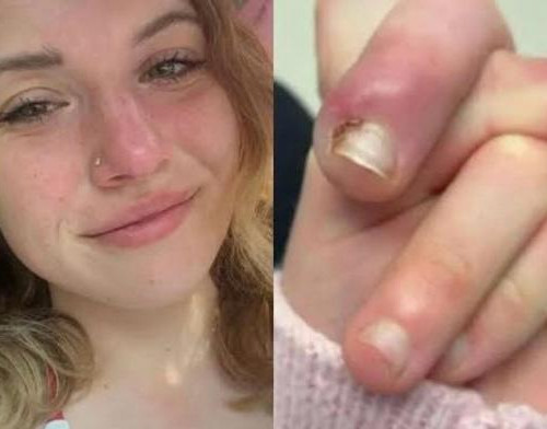 Jovem de 21 anos quase perde o dedo após infecção causada por roer unhas