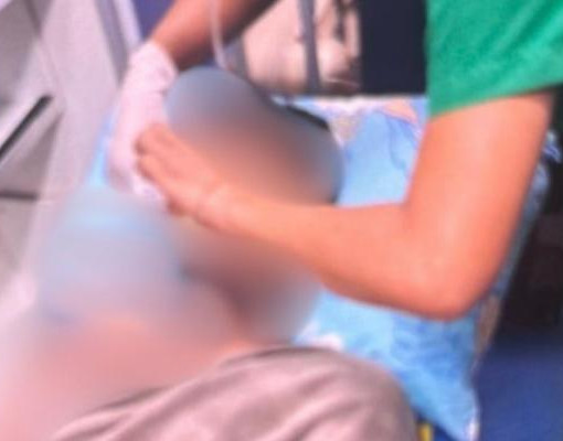 Jovem de 21 anos tem rosto e braço queimados após ataque com água quente em Corrente