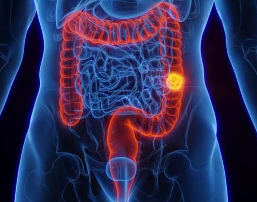 SUS passa a oferecer exame gratuito para detectar câncer intestinal