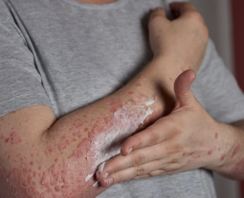 Alta taxa de hanseníase coloca o Piauí entre os estados mais afetados do país