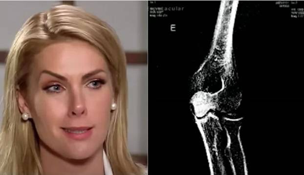 Raio-x confirma lesão de Ana Hickmann após agressão do marido.