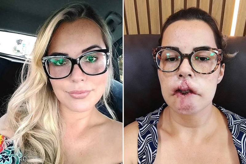 Mulher perde lábio após procedimento estético