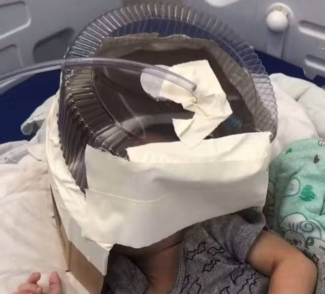 Hospital improvisa máscara de oxigênio com embalagem de bolo para atender bebê